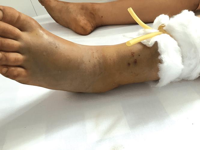 新澳门彩开奖结果今天和被蛇咬两年仍后遗症与被蛇咬了几年后身体有毒素吗